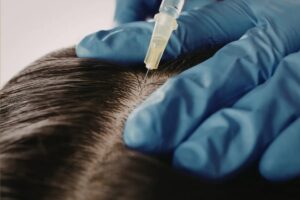 Advanced Scalp Treatment Offers New Hope for Hair Loss Solutions in the Philippines